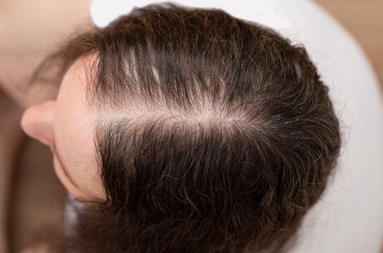 Female pattern baldness in 20s