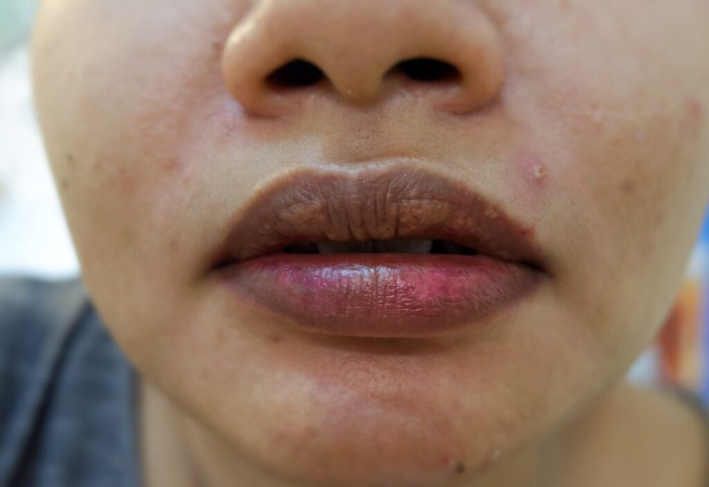 Lip Pigmentation Treatment